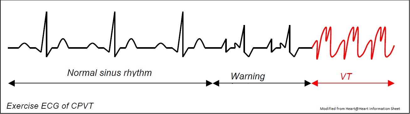 Catecholaminergic Polymorphic Ventricular Tachycardia (CPVT) – CIDG