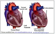 Left Ventricular Non-Compaction Cardiomyopathy – CIDG